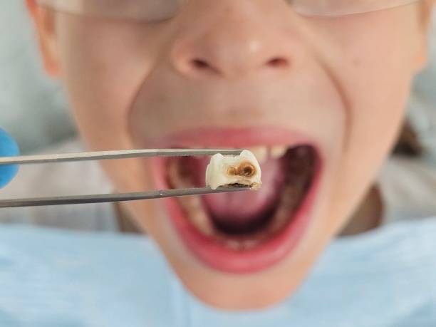 Best Chipped Tooth Repair Near Me  in Pleasant Ridge, MI